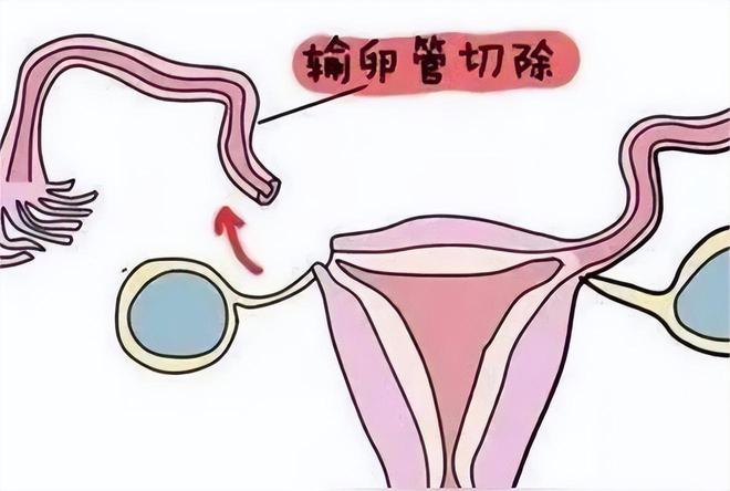 捐卵费用