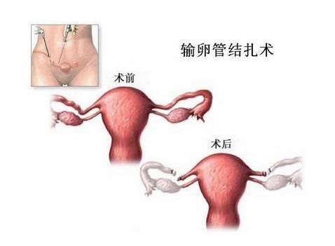 杭州捐卵